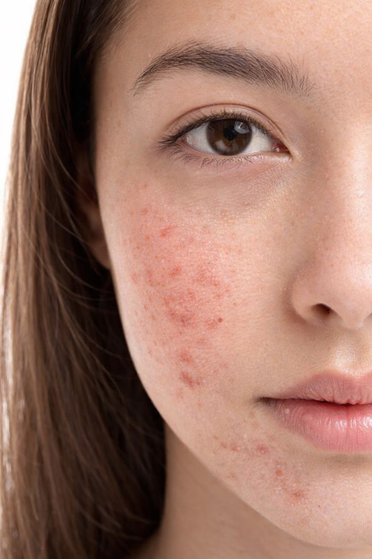 Before Lumina - Acne